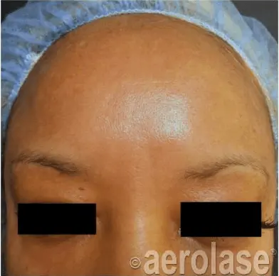 after treatment - melasma and pigment spots