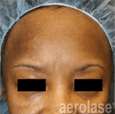 before treatment - melasma and pigment spots